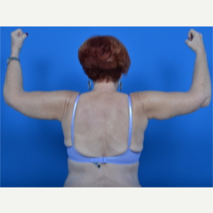 67 year old female - arm lift (brachioplasty) after 3327805