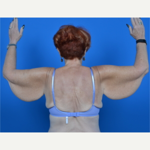 67 year old female - arm lift (brachioplasty) before 3327805