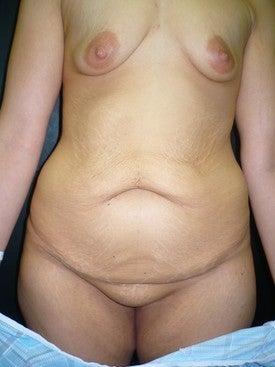 Breast and Tummy tuck after Weight Loss before 470241