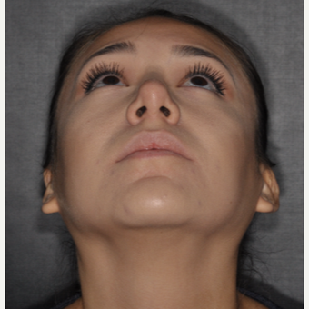 18-24 year old woman treated with Rhinoplasty 1 year post-op. after 3708692