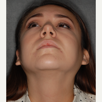 18-24 year old woman treated with Rhinoplasty 1 year post-op. before 3708692