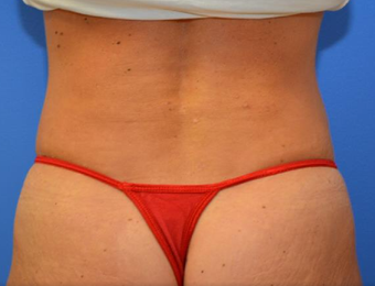 45-54 year old woman treated with CoolSculpting after 2065157