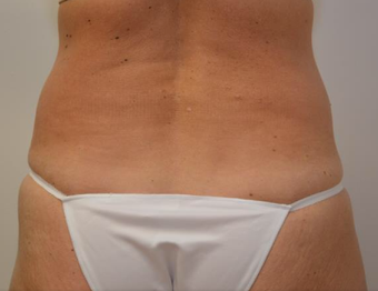 45-54 year old woman treated with CoolSculpting before 2065157