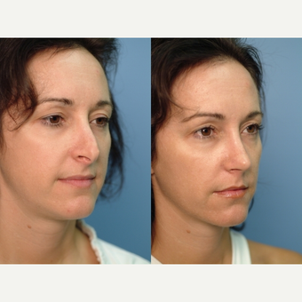 35-44 year old woman treated with Revision Rhinoplasty 2682497
