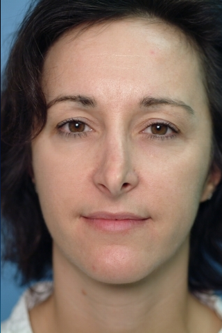35-44 year old woman treated with Revision Rhinoplasty before 2682497