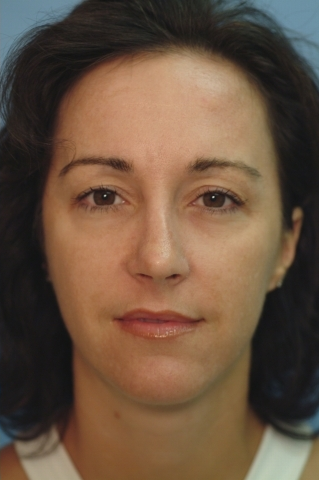 35-44 year old woman treated with Revision Rhinoplasty after 2682497