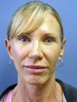 55-64 year old woman treated with Neck Lift before 3103897