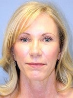 55-64 year old woman treated with Neck Lift after 3103897