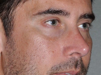 45 Year Old Male Who Desired Stronger Appearing Cheeks after 806509