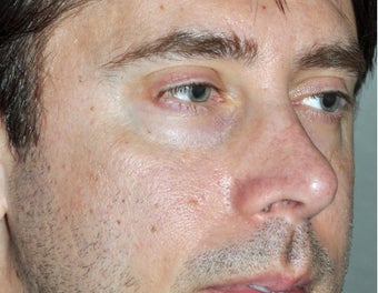 45 Year Old Male Who Desired Stronger Appearing Cheeks before 806509