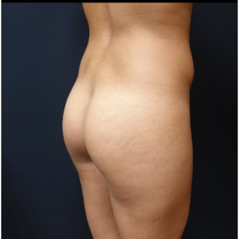 25-34 year old woman treated with 548cc Round Silicone Butt Implants for her Butt Augmentation before 3033291