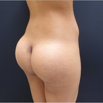 25-34 year old woman treated with 548cc Round Silicone Butt Implants for her Butt Augmentation after 3033291