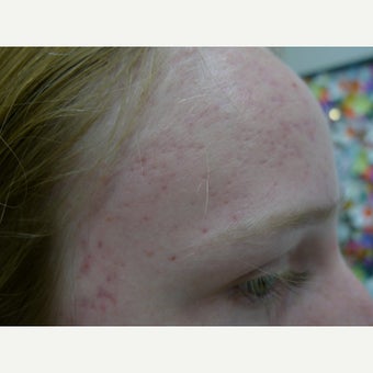 Acne Free RF before 2007435