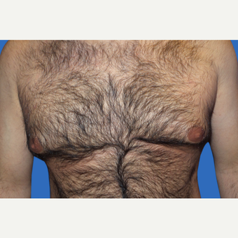 35-44 year old man treated with Male Breast Reduction before 3168659
