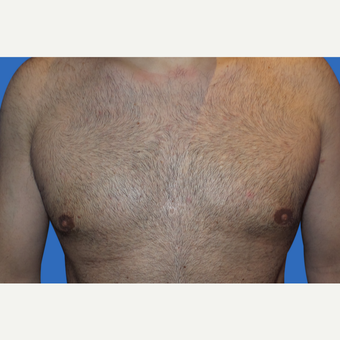 35-44 year old man treated with Male Breast Reduction after 3168659