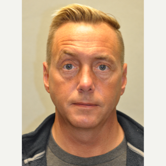 45-54 year old man treated with Rhinoplasty after 3522181