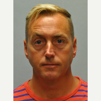 45-54 year old man treated with Rhinoplasty before 3522181