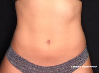 Kybella Fat Reduction in Lower Abdomen after 3264446