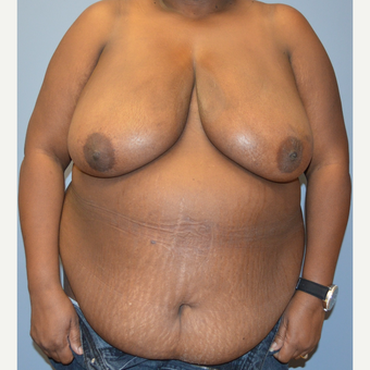 55-64 year old woman treated with Breast Reconstruction before 3168157