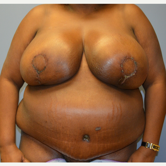 55-64 year old woman treated with Breast Reconstruction after 3168157