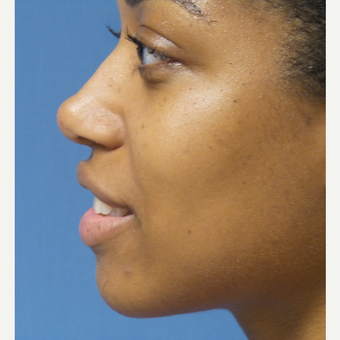 25-34 year old woman treated with African American Rhinoplasty after 3098272