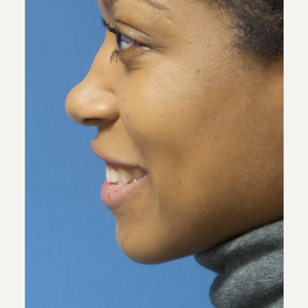 25-34 year old woman treated with African American Rhinoplasty before 3098272