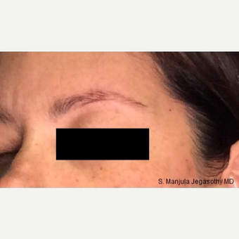 Nonsurgical Browlift with Ultherapy® after 3701606