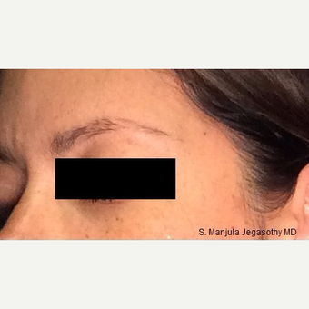 Nonsurgical Browlift with Ultherapy® before 3701606