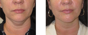 Chin liposuction/Liposculpture before 1007697