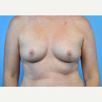 35-44 year old woman treated with Breast Implants before 3440895