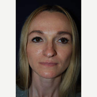 25-34 year old woman treated with Rhinoplasty before 3093493