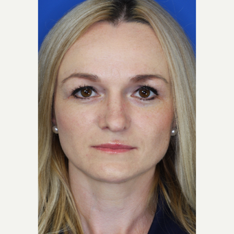 25-34 year old woman treated with Rhinoplasty after 3093493