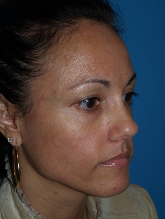 "V" Lift for cheek enhancement using HA filler before 1222988