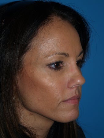 "V" Lift for cheek enhancement using HA filler after 1222988