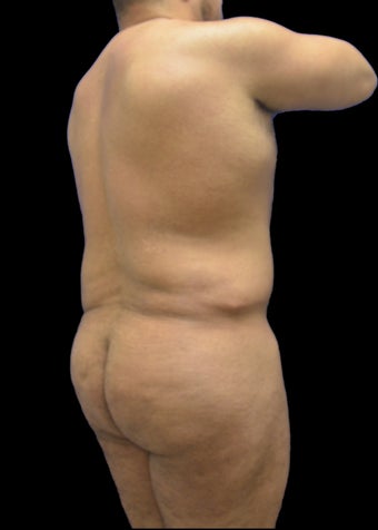 35-44 year old man treated with VASER Shape before 3220611