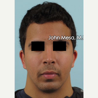 25-34 year old man treated with Buccal Fat Removal before 3266754