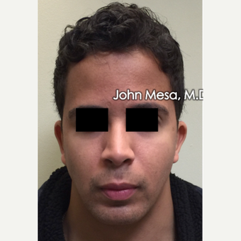 25-34 year old man treated with Buccal Fat Removal after 3266754