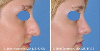 25-34 year old woman treated with Nose Surgery before 3810073