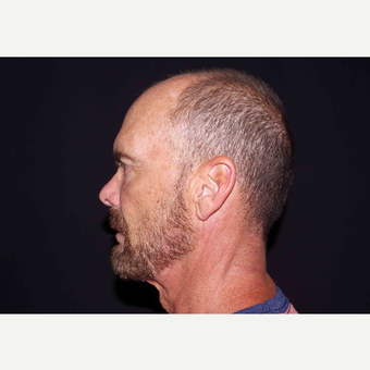 55-64 year old man treated with Bellafill after 3439474
