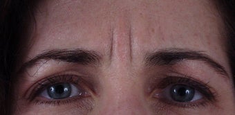 Botox to forehead "11" lines before 240863