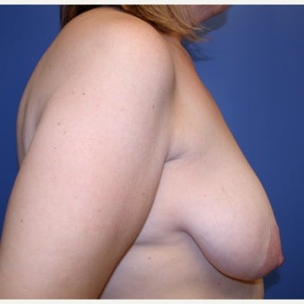 45-54 year old woman treated with Breast Lift with Implants 1581381