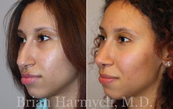 16 year-old female before and one year after Rhinoplasty before 3447322