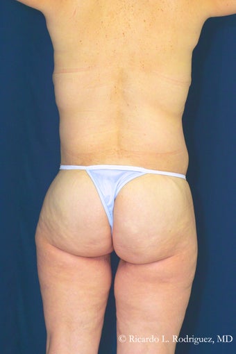 Lower Body Lift after 100665