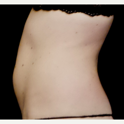 25-34 year old woman treated with truSculpt before 3564732