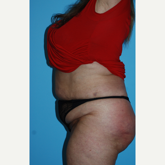 65-74 year old woman treated with SculpSure of the flanks and abdomen after 3690193
