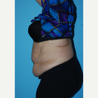 65-74 year old woman treated with SculpSure of the flanks and abdomen before 3690193