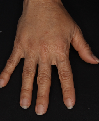 Radiesse to Hands 301223