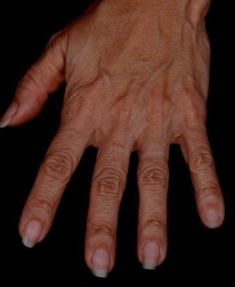 Radiesse to Hands before 301223