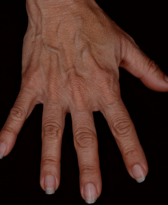 Radiesse to Hands 301223