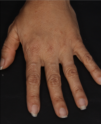 Radiesse to Hands after 301223